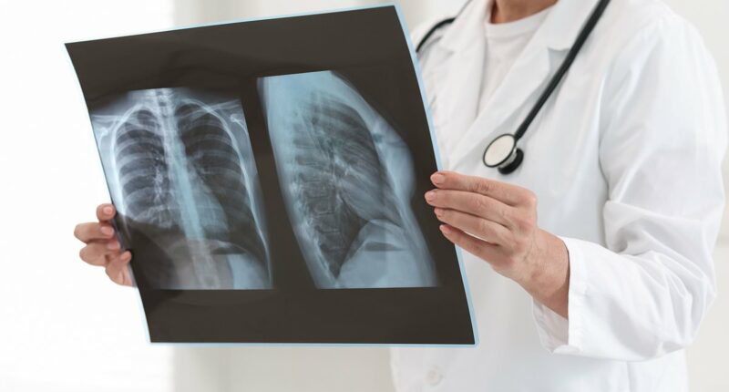 Severe cases of covid and the flu linked to increased lung cancer risk years after recovery, warns new study
