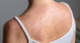 Terrifying measles side effect lurking in kids and killing years later