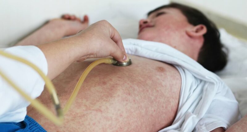 Thousands at risk of deadly complications after measles exposure