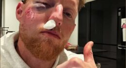 Stokes said he is ‘lucky’ to be alive after a ball broke his cheekbone during a net session at Durham in February
