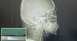 Chinese boozer spends 8 years with metal chopstick stuck in his throat before having doctors remove it