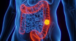 Groundbreaking bowel cancer trial follow-up shows zero relapses
