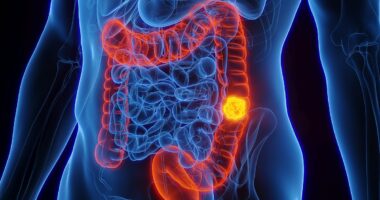 Groundbreaking bowel cancer trial follow-up shows zero relapses
