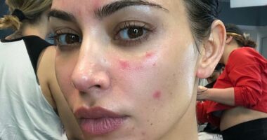 How to cure psoriasis WITHOUT drugs: ETHAN ENNELS reveals the answers