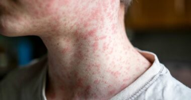 Thousands exposed to measles after American with confirmed case traveled through major airport