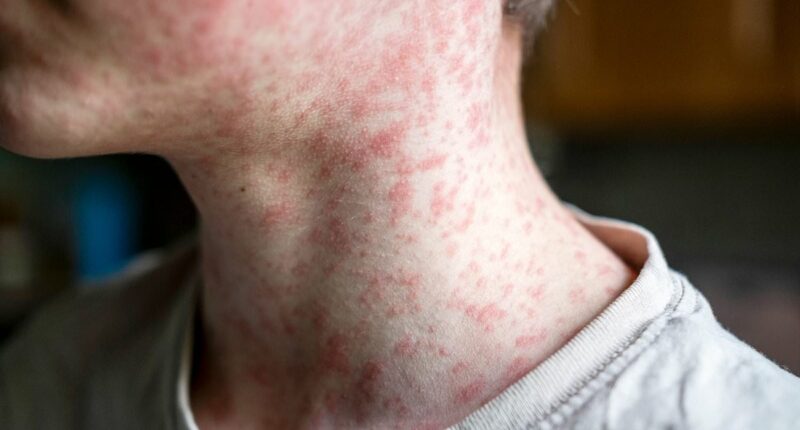Thousands exposed to measles after American with confirmed case traveled through major airport
