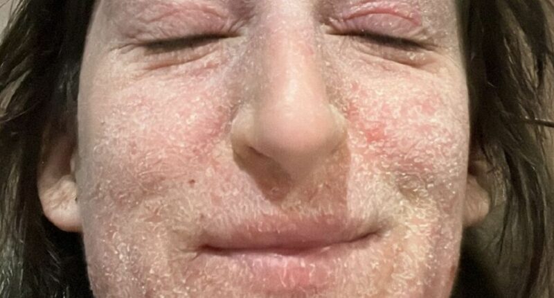 Woman left 'like alien' after 28 years of eczema cream believes it's to blame