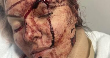 Charlie Teo's girlfriend speaks out after suffering horror injuries