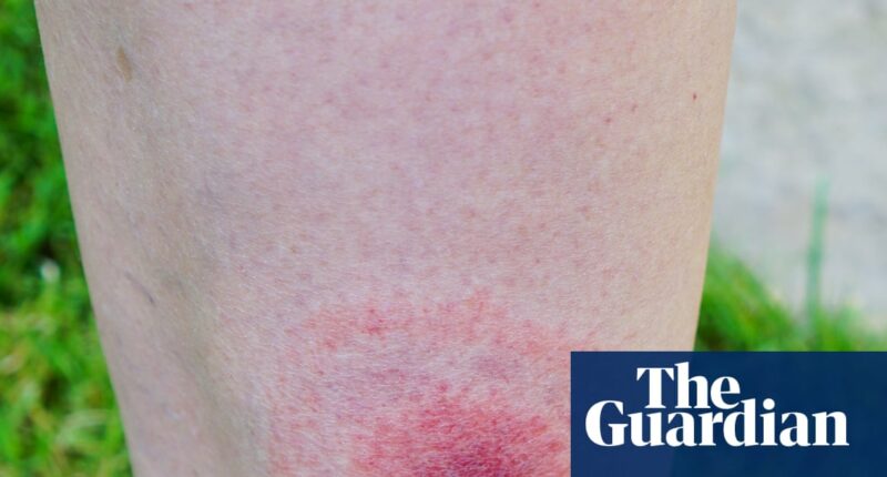 Lyme disease cases in England rise by more than 20% in a year
