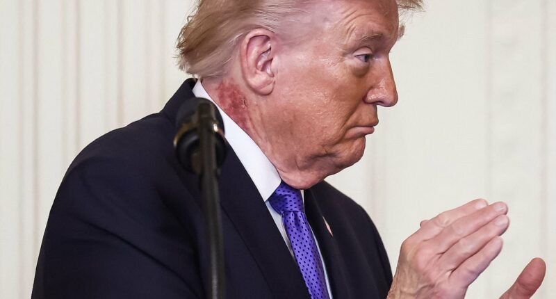 Trump's delayed physical results raise eyebrows amid worries about his constant hand bruises