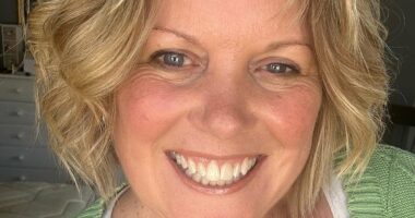 Woman, 54, shows off incredible results after removing 'snake' vein