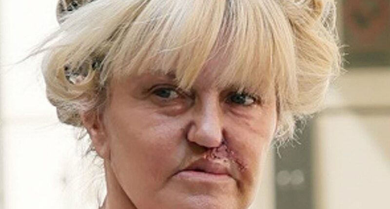 Danniella Westbrook reveals scars from facial reconstruction surgery