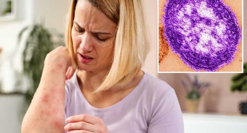 Measles emerges in California wastewater as health experts sound alarm