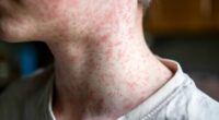 Measles surge sparks fears US could jeopardize elimination status