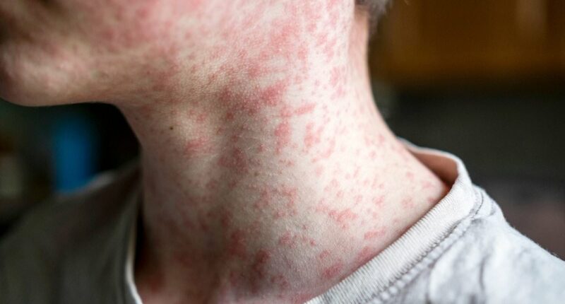Measles surge sparks fears US could jeopardize elimination status