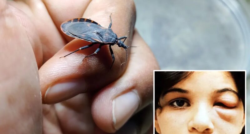 Case of deadly 'kissing bug' found in California -- and sufferers may not even know they have it