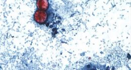Parasite outbreak causing 'explosive diarrhea' reported in 17 US states, CDC warns