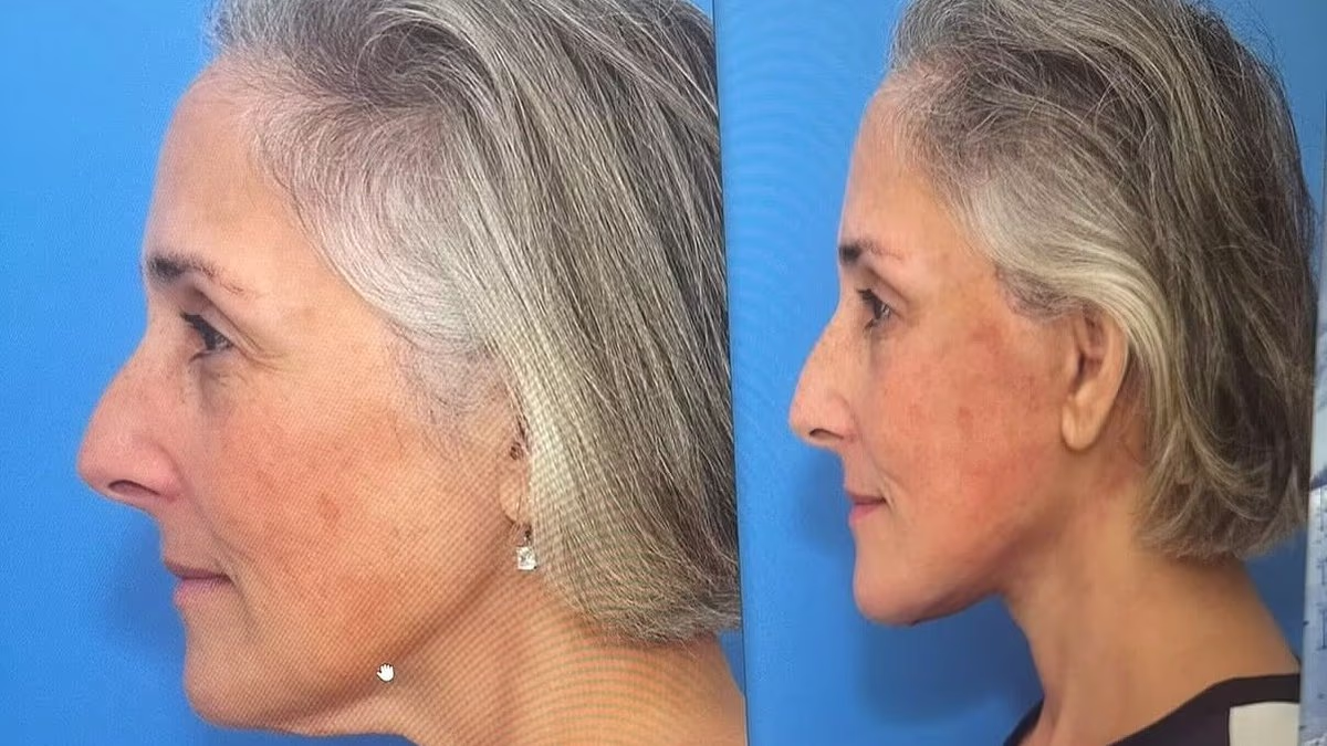 Ricki Lake, 57, Reveals Before-and-After Facelift Photos