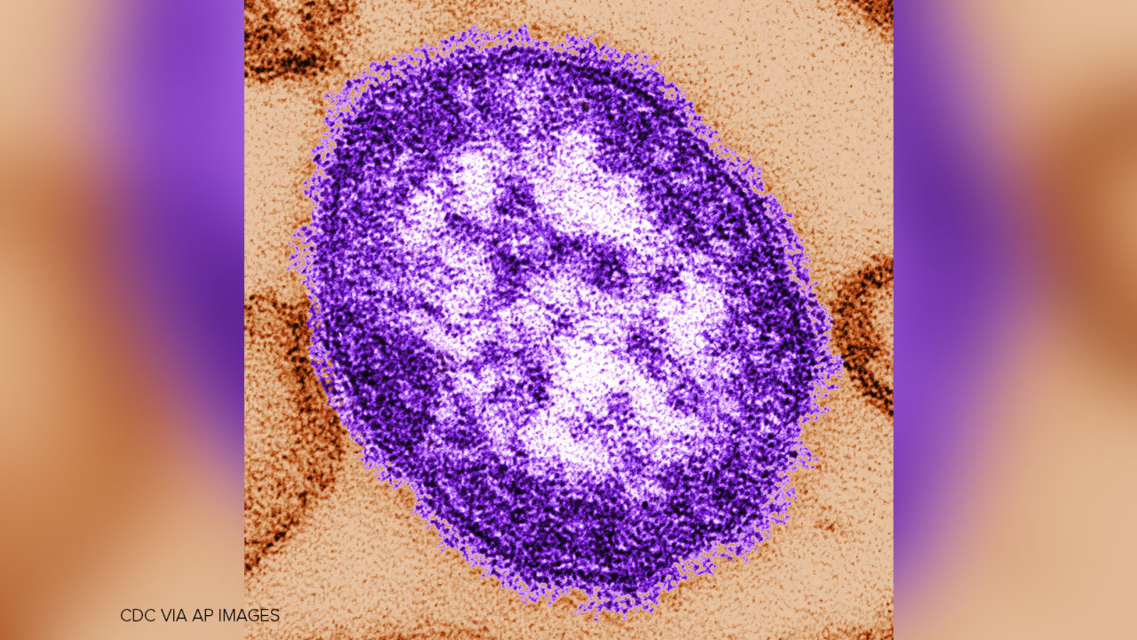 US Measles Cases Hit 35-Year High for Second Straight Year