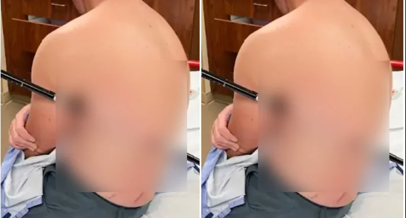 Montana Hiker Impaled by Trekking Pole Treks Out for Help - Internewscast Journal