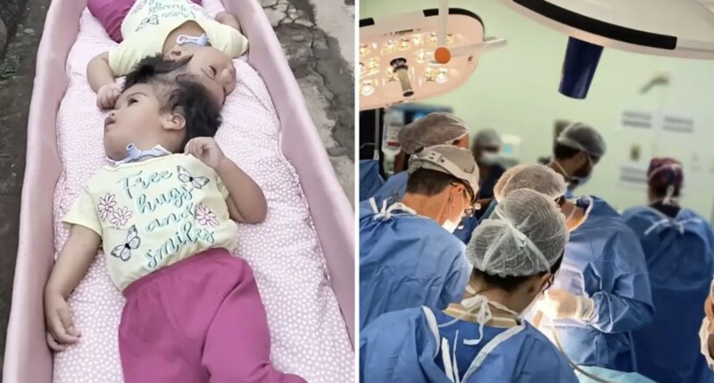 Conjoined twin girls, 2, die minutes after being separated following five grueling surgeries