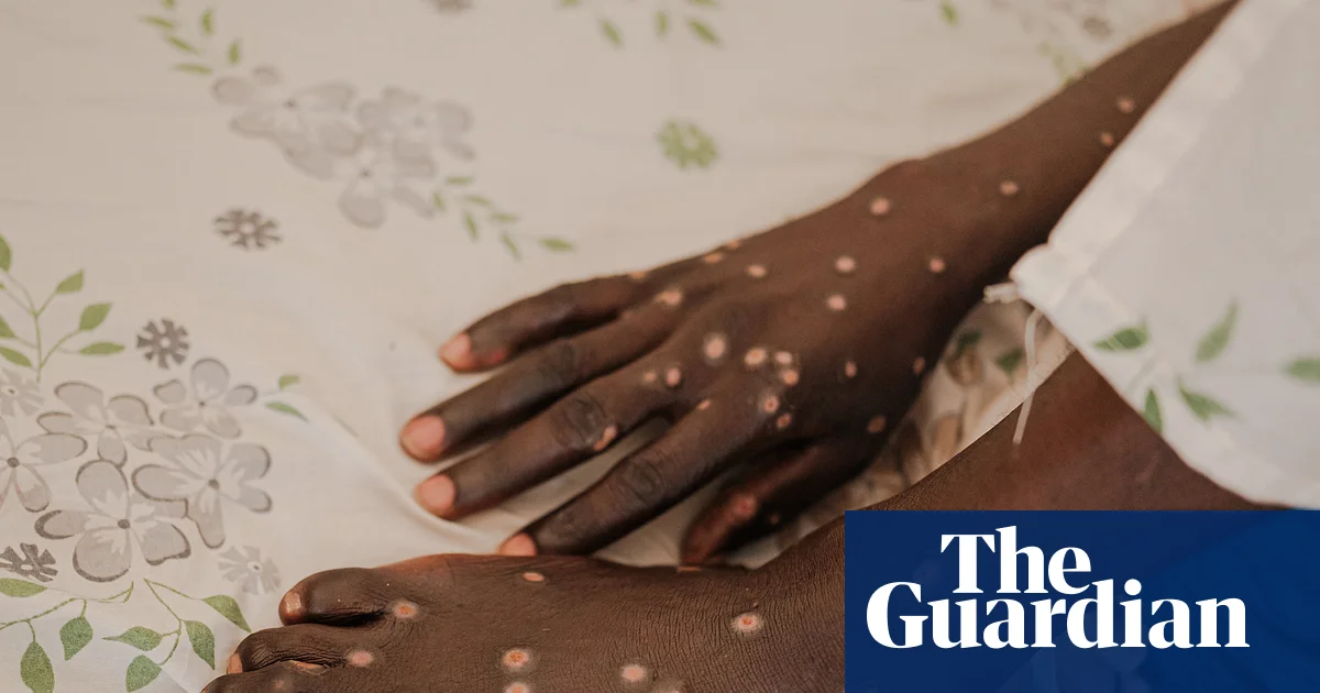 Mpox Outbreak Spreads to New Countries: How to Contain It