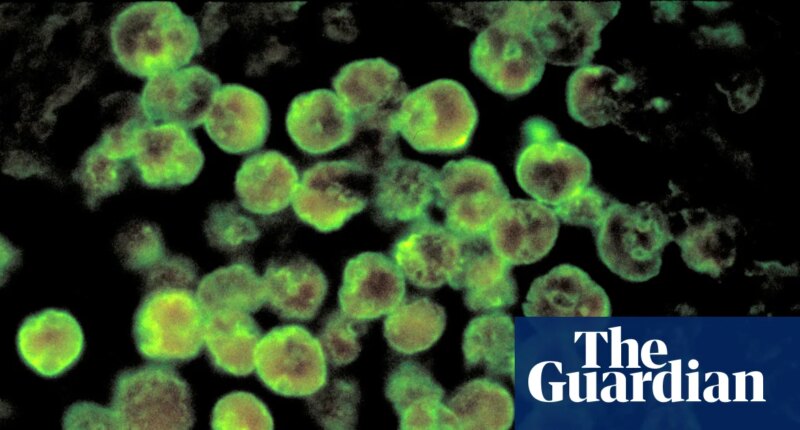 North Carolina teenager dies from rare infection caused by brain-eating amoeba
